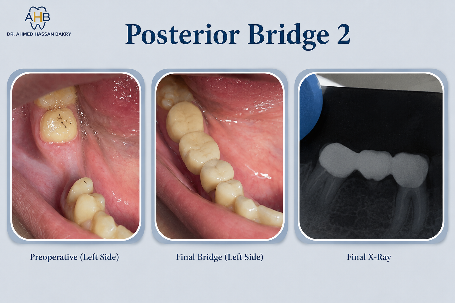Posterior Bridge (Case 2)